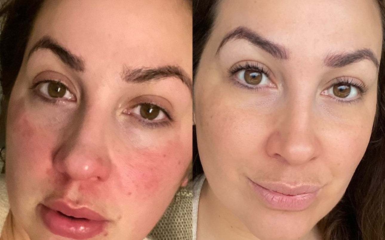 Best Skin Care Routine for Acne & Oily Skin | UpCircle - UpCircle Beauty