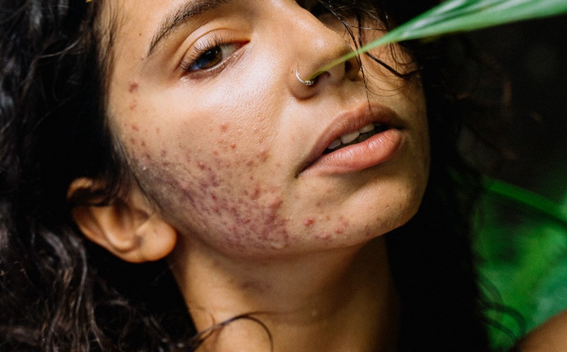 Top Tips For Looking After Spot Prone Skin & Acne